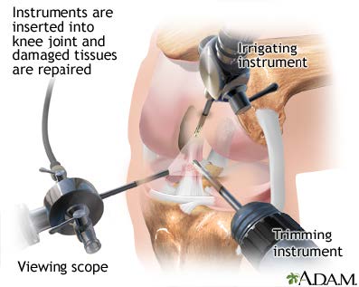 acl reconstruction