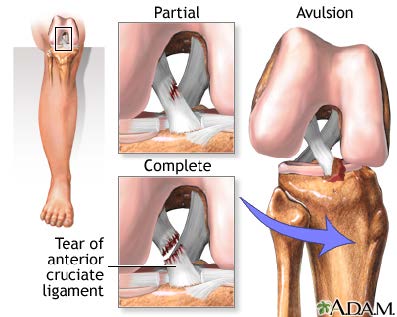 anterior cruciate ligament