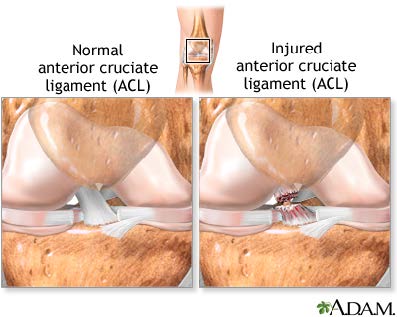 ACL injury5 Dr. CL Steyn Inc Shoulder, Hip & Knee Surgeon Cape Town