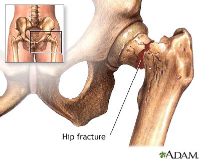 Minimally Invasive, Minimally Invasive Hip Replacement