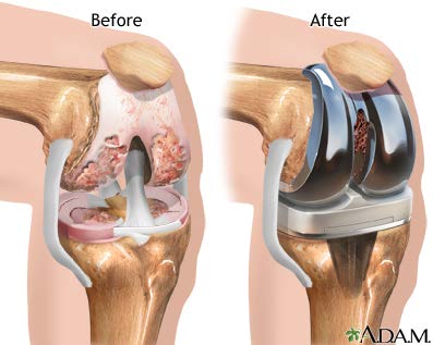 Knee Joint Replacement