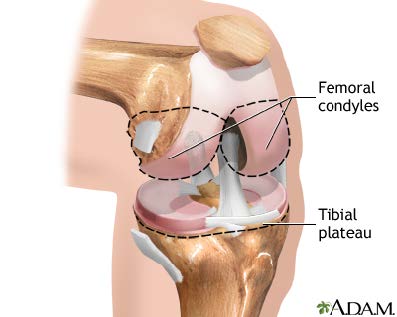 kneecap dislocation