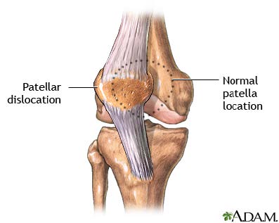 Kneecap dislocation2 Dr. CL Steyn Inc Shoulder, Hip & Knee Surgeon Cape Town