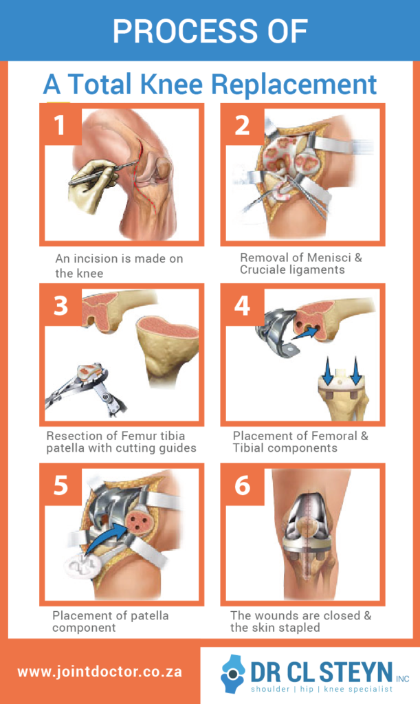 knee replacement, surgery, knee arthroplasty, total knee replacement