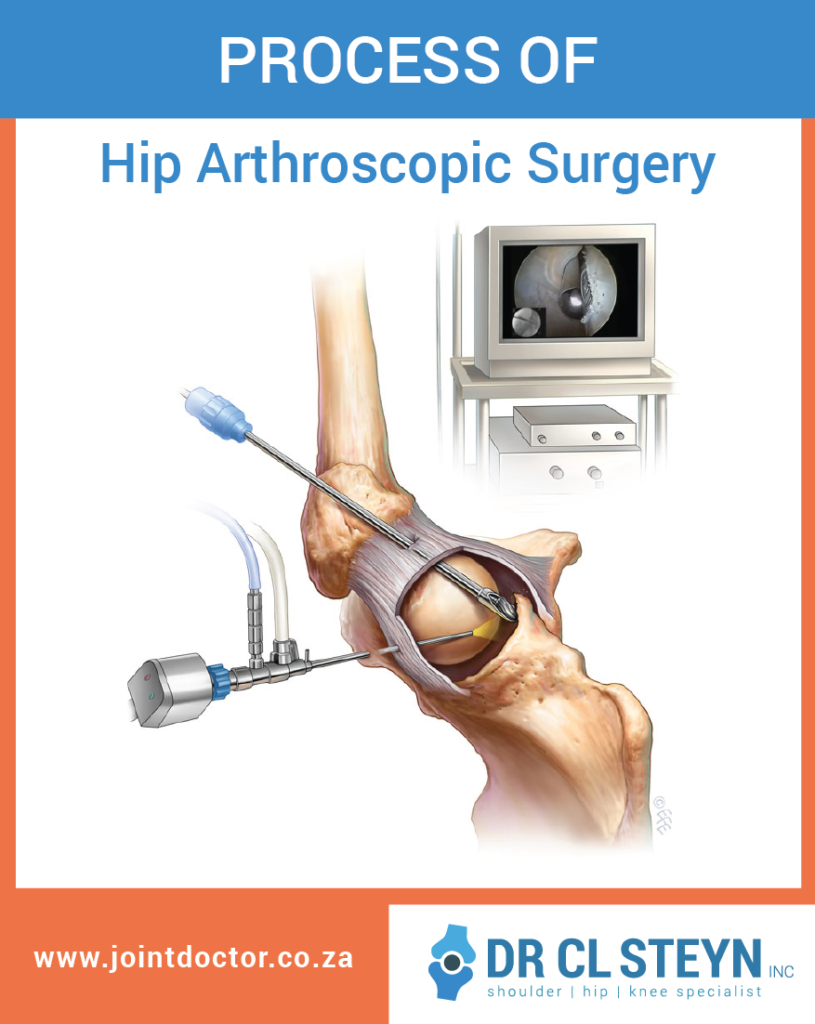 arthroscope, hip