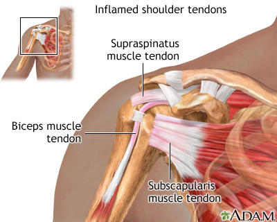 frozen shoulder