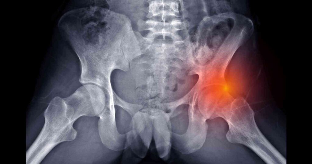 hip pain, Hip joint, Hip fractures, Non-surgical, treatments Hip replacement surgery